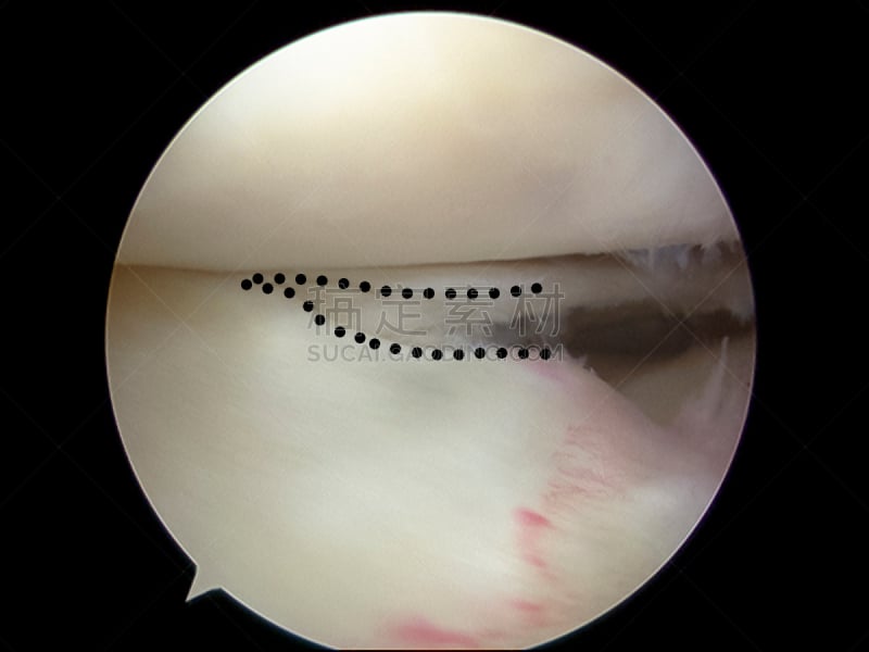 外侧半月板,运动模糊,扯开,半月状软骨,关节镜手术,内诊镜,水平画幅,健康保健,手术器械