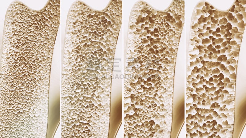 骨质疏松症,数字4,三维图形,洞,水平画幅,衰老过程,损失,人,科学,生物学