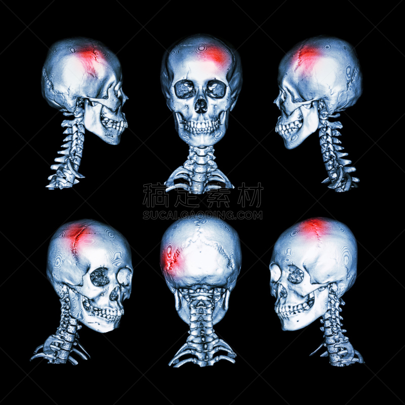 头骨,状态,脑部手术,颈椎,神经病,3d扫描,cat扫描仪,英文字母x,神经外科,人头骨