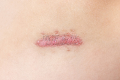 皮肤病学,瘢痕瘤,疤,概念,皮肤,特写,美容院,肿胀的,健康保健