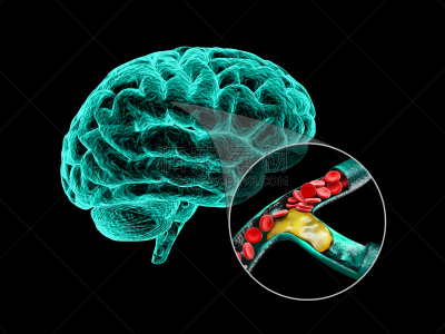 硬化症,绘画插图,人脑,脑,三维图形,白昼,五月,健康保健,图表