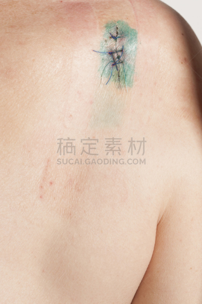 皮肤癌,皮肤,垂直画幅,疤,真皮层,仅男人,仅成年人,检查,耐性,后背