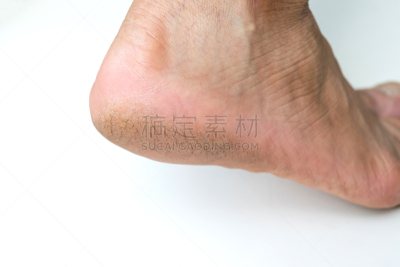 足,背景聚焦,破碎的,皮炎,皮肤病学,粗糙的,身体受伤,水平画幅,古老的,健康