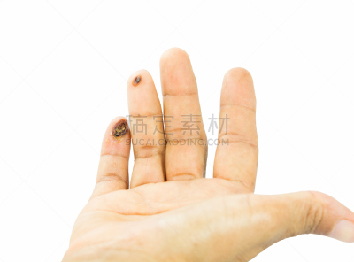 手指,水泡,身体受伤,水平画幅,疣,疙瘩,特写,部分,白色,囊肿