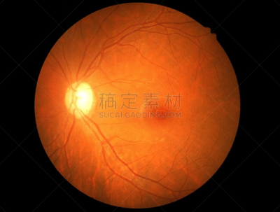视网膜,糖尿病,糖尿病视网膜病,睫状突,器官底部,室内管弦乐队,验光师,洞,水平画幅,拉格啤酒