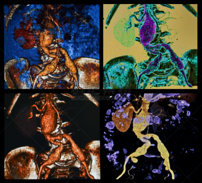 ct检查,动脉瘤,维管束,cat扫描仪,水平画幅,主动脉,科学成像技术,摄影