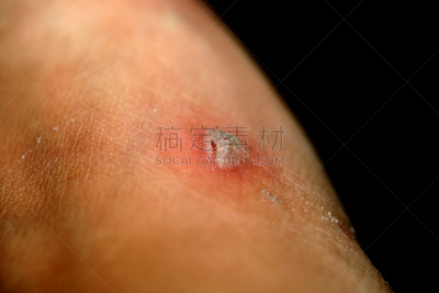玉米,药,皮肤,放气的,过氧化氢,脚病医生,不舒服,美,替代疗法,辅导讲座