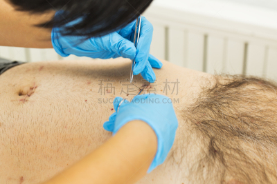 腹腔镜手术,胆囊,病人,胆石,手术剪刀,水平画幅,医疗流程,疤,腹腔,健康保健