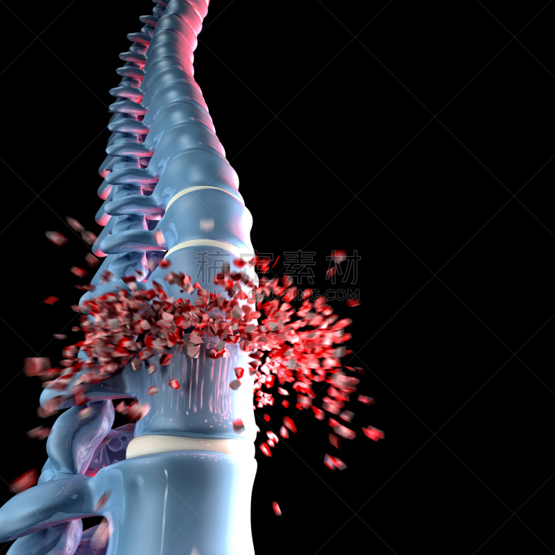 骨骼,三维图形,整形器具,人,骨细胞,腰椎,椎间盘突出,椎间盘,磁盘,背痛