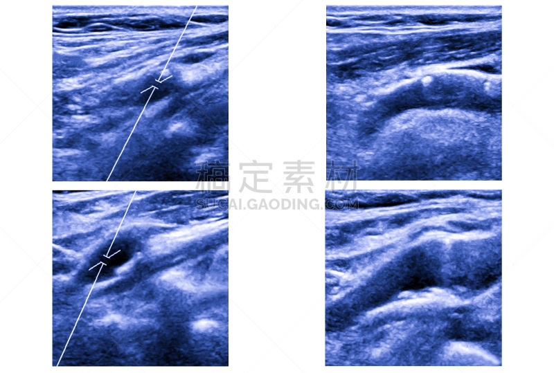 超声波,绘画艺术品,颈动脉,水平画幅,噪声,图像,白色,技术,雷达