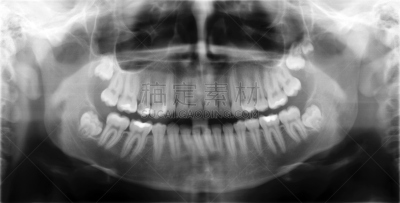 x光,照片,颌骨,底片效果,水平画幅,x光片,真实的人,人,单色调,人头骨