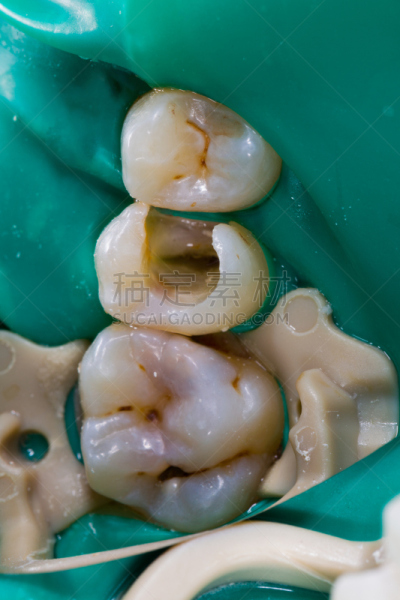 药,根管,垂直画幅,状态,罗马尼亚,诊疗室,龋齿,根部,医疗流程,运河