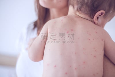 水痘,母亲,婴儿,多次划破,麻疹,疹,麻疹病毒属,尿布,炎症,12到17个月