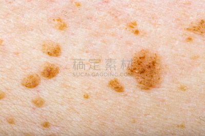 皮肤,大量物体,褐色,四肢,水平画幅,癌症,黑素细胞,白人,特写,皮肤癌