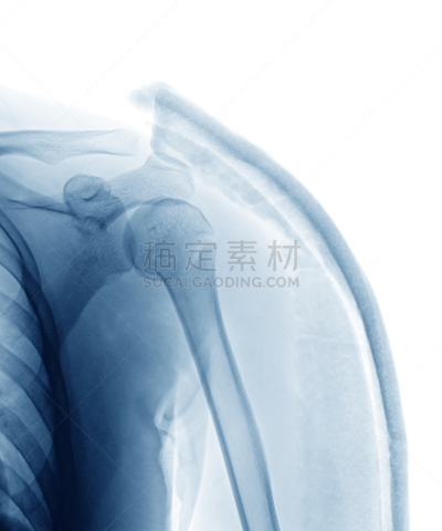 肩,x光片,垂直画幅,石膏,身体受伤,人类骨架,四肢,科学,偏远的,肩胛骨