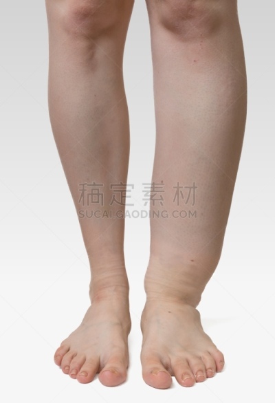 腿,病人,悲痛,象皮病,肿胀的,淋巴系统,奇形怪状的,排水口,垂直画幅