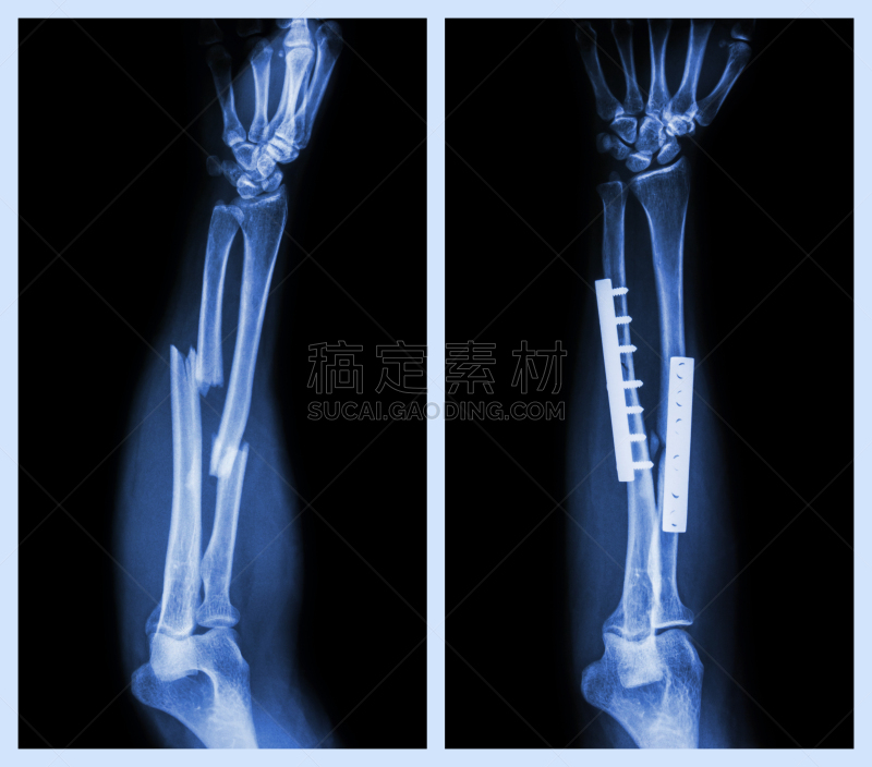 前臂,骨骼,桡骨,肘,身体受伤,人类骨架,四肢,水平画幅,海产,金属