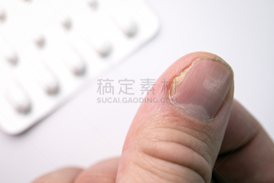 甲真菌病,特写,动物手指,拇指,健康保健,钉子,拉脱维亚,药,皮肤病学