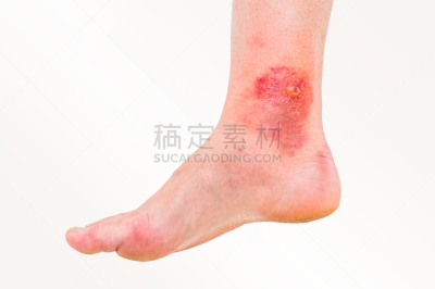 红色,昆虫,皮疹,平衡折角灯,咬一口,病人,淋巴系统,牛皮廯,皮炎,湿疹