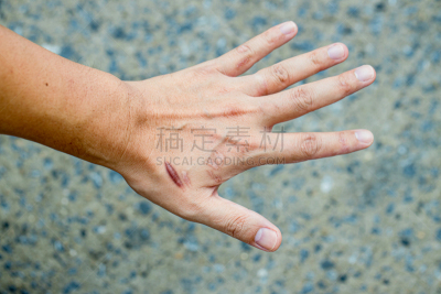 皮肤,手,疤,男人,瘢痕瘤,手腕,意外事件,修改系列,手术