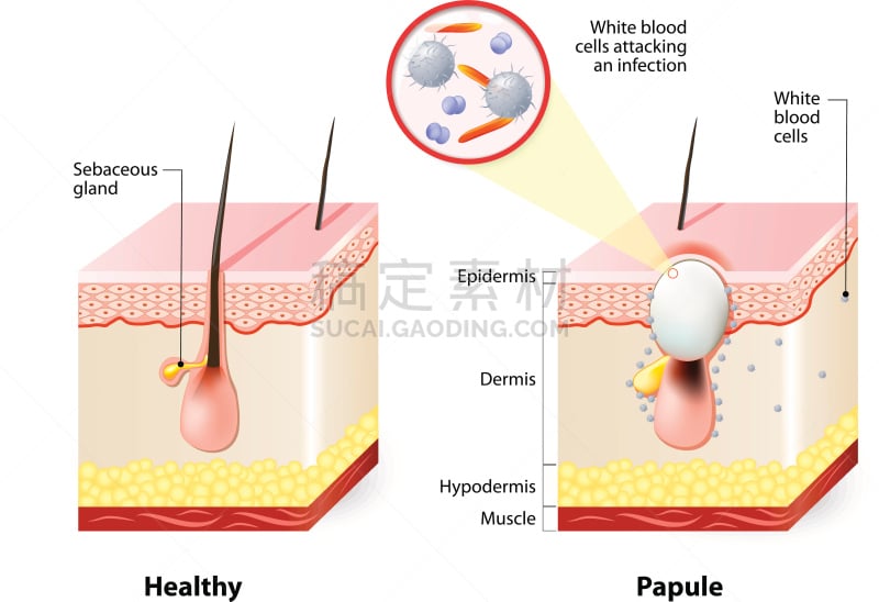 健康保健,皮肤,皮脂,皮脂腺,粉刺,真皮层,毛囊,人类腺体,多孔渗水的,疙瘩