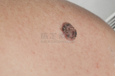 皮肤癌,皮肤,疤,真皮层,仅男人,仅成年人,检查,耐性,后背,基皮细胞癌
