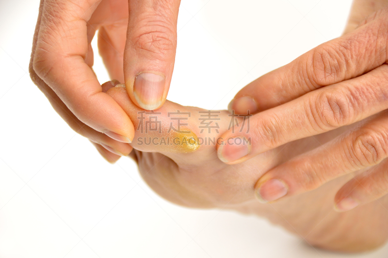 人类脚趾,甲真菌病,水泡,毛木耳,畸形,血凝结,肿胀的,瘀伤,仅一个老年女人,悲痛