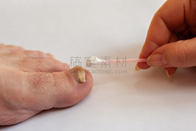棉签,真菌,手,趾甲,女性,奶油,健康保健,部分,化妆棉,药