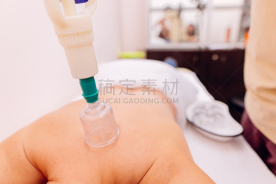 拔罐,精神科医生,女人,健康保健工作人员,专业人员,药,杯,另类生活方式,中国,吸气管