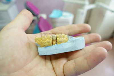 牙医,灰膏,牙冠,手,牙齿,模型,特写,安全护栏,医疗用品,口腔卫生
