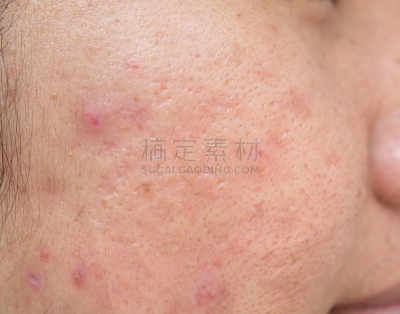 疤,人的脸部,瘢痕瘤,瘀伤,健康保健,药,泰国,移开,缝线