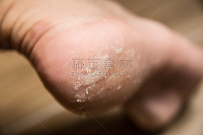 足,特写,踮着脚尖,皮炎,卫生,皮肤病学,摩尔多瓦共和国,图像,破碎的,损坏的
