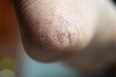 破碎的,皮肤,足,暴力,特写,水泡,部分,韧性,皮肤病学,健康