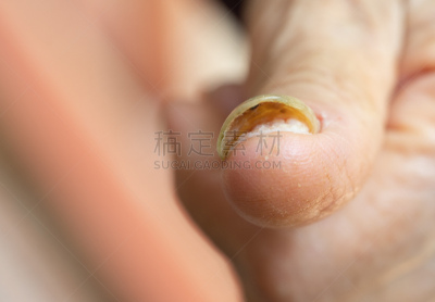 指甲,健康保健,药,皮肤病学,肮脏的,真菌,问题,不舒服