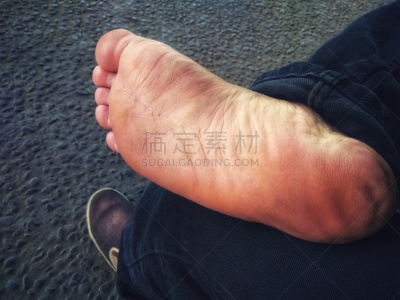 肮脏的,干净,破碎的,足,健康保健,皮炎,部分,背景分离,皮肤病学