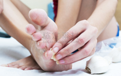 药,自然,有疣的,健康保健,替代医药,罗马尼亚,皮肤病学,腿,跖疣