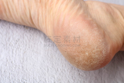 健康保健,白色,图像,足,特写,概念,皮炎,药,鞋子,腿