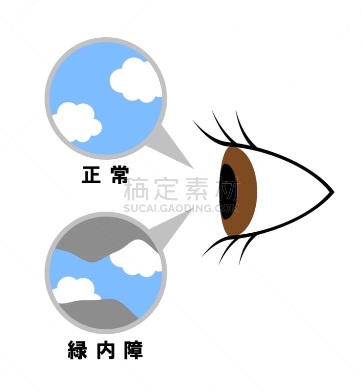 青光眼,症状,健康保健,身体状况,状态,图表,生物医学插图,垂直画幅,视力,无形的