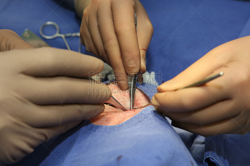 眼部手术,速度滑冰,人,手术钉,视网膜,解剖刀,手术室,手术缝合,验光师,水平画幅