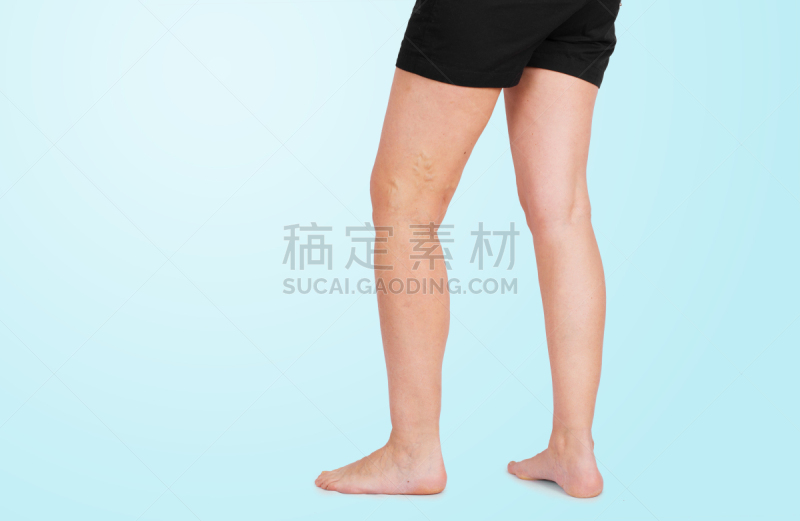 女性,腿,静脉曲张,留白,水平画幅,巨大的,仅成年人,肿胀的,耐性,痛苦
