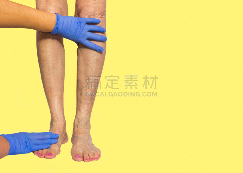 腿,静脉曲张,女性,水平画幅,衰老过程,古老的,巨大的,肿胀的,痛苦