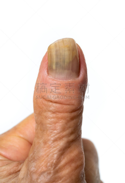 真菌,指甲,健康保健,背景分离,药,肮脏的,问题,不舒服,甲真菌病