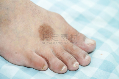 皮炎,足,黑色,圆形,健康保健,部分,背景分离,皮肤病学,泰国,腿