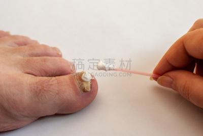 棉签,真菌,手,趾甲,女性,奶油,健康保健,部分,化妆棉,药