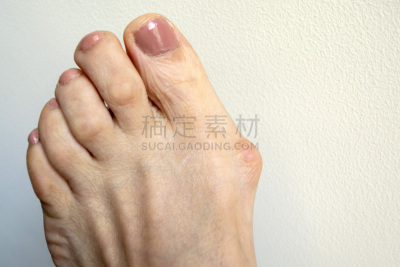 拇趾囊肿胀,足,女性,大脚趾,健康保健,部分,背景分离,腿,波斯湾