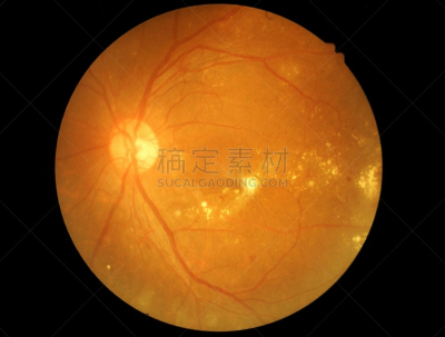 视网膜,糖尿病,睫状突,糖尿病视网膜病,器官底部,室内管弦乐队,验光师,洞,水平画幅,拉格啤酒